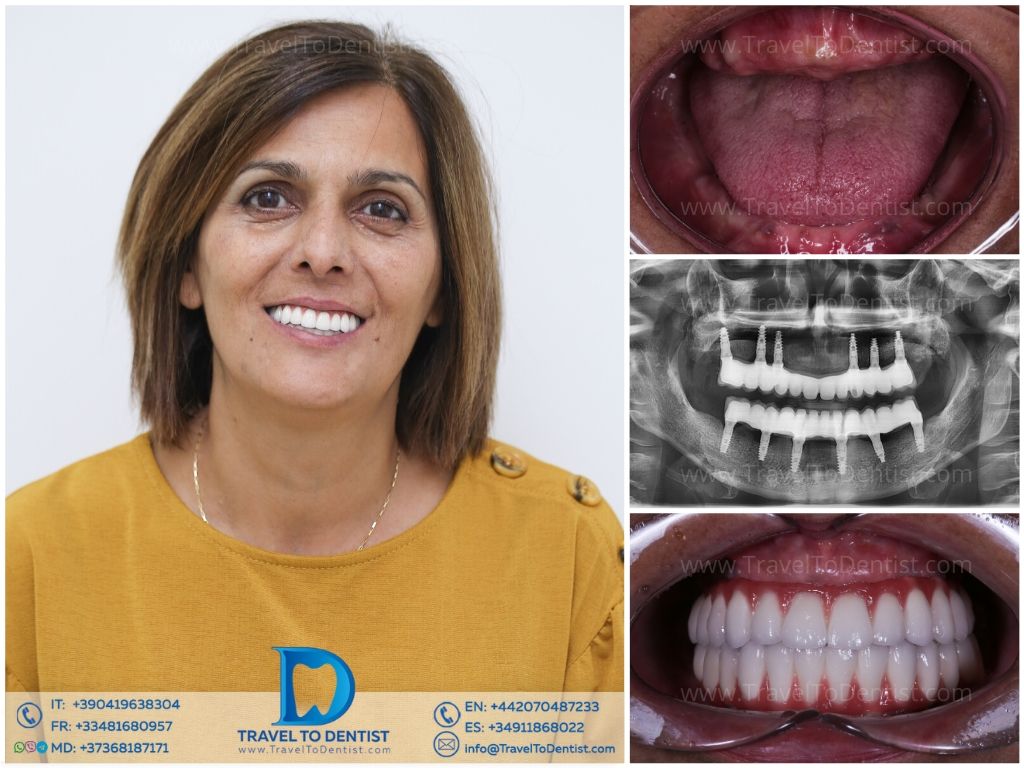 Caso dental 5 – Sonrisa perfecta