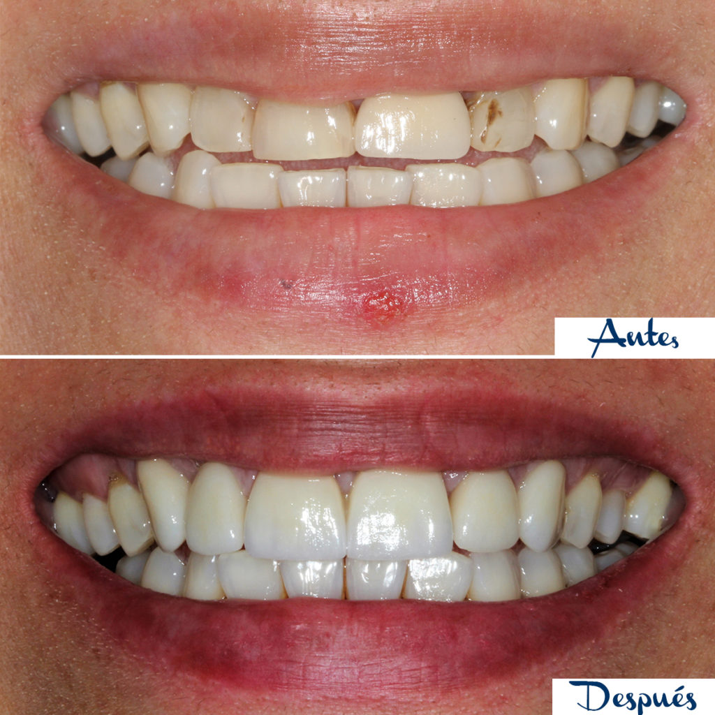 Caso dental 1 – Transformación de sonrisa