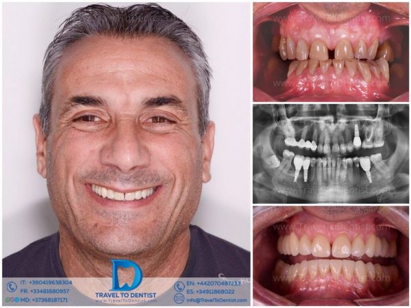 Caso dental 2 – Resultado ortodoncia